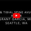 Dr. Garcia’s newest technique to fix ACL tibial spine using the new
ACL tightrope system 