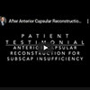 Video testimonial after Anterior Capsular Reconstruction a novel technique for revision subscapularis repair.
