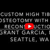 Dr. Garcia’s technique for a High tibial osteotomy with an ACL
reconstruction using a 3D printed custom guide.