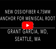 First OssioFiber Anchor for Meniscal Root Repair on the West Coast.